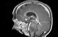 Axial MRI slice with PediaFlow segmentation overlay